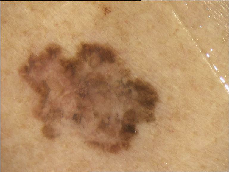 melanoma cutaneo